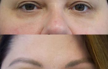 48 year-old patient before and 3 months after an Upper Blepharoplasty (Eyelid Lift), Mini Temple Lift and TCA Peel