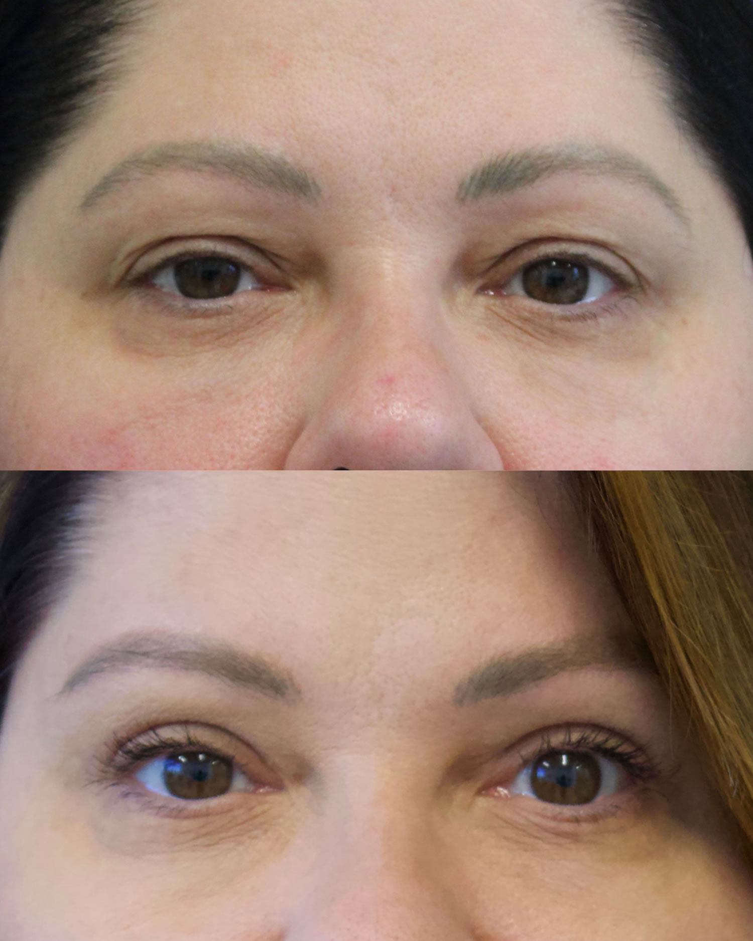 48 year-old patient before and 3 months after an Upper Blepharoplasty (Eyelid Lift), Mini Temple Lift and TCA Peel