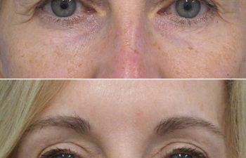 57 year-old before and 1 year after upper eyelid lift (upper blepharoplasty), lower eyelid surgery (lower blepharoplasty), brow lift, fat grafting to the face, and a TCA peel