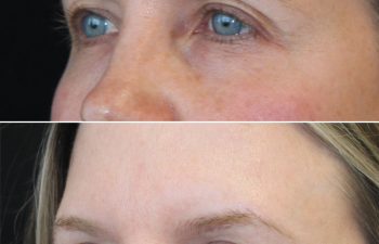 48 year-old before and 6 months after upper eyelid lift with Dr. Maia in Tysons Corner, VA