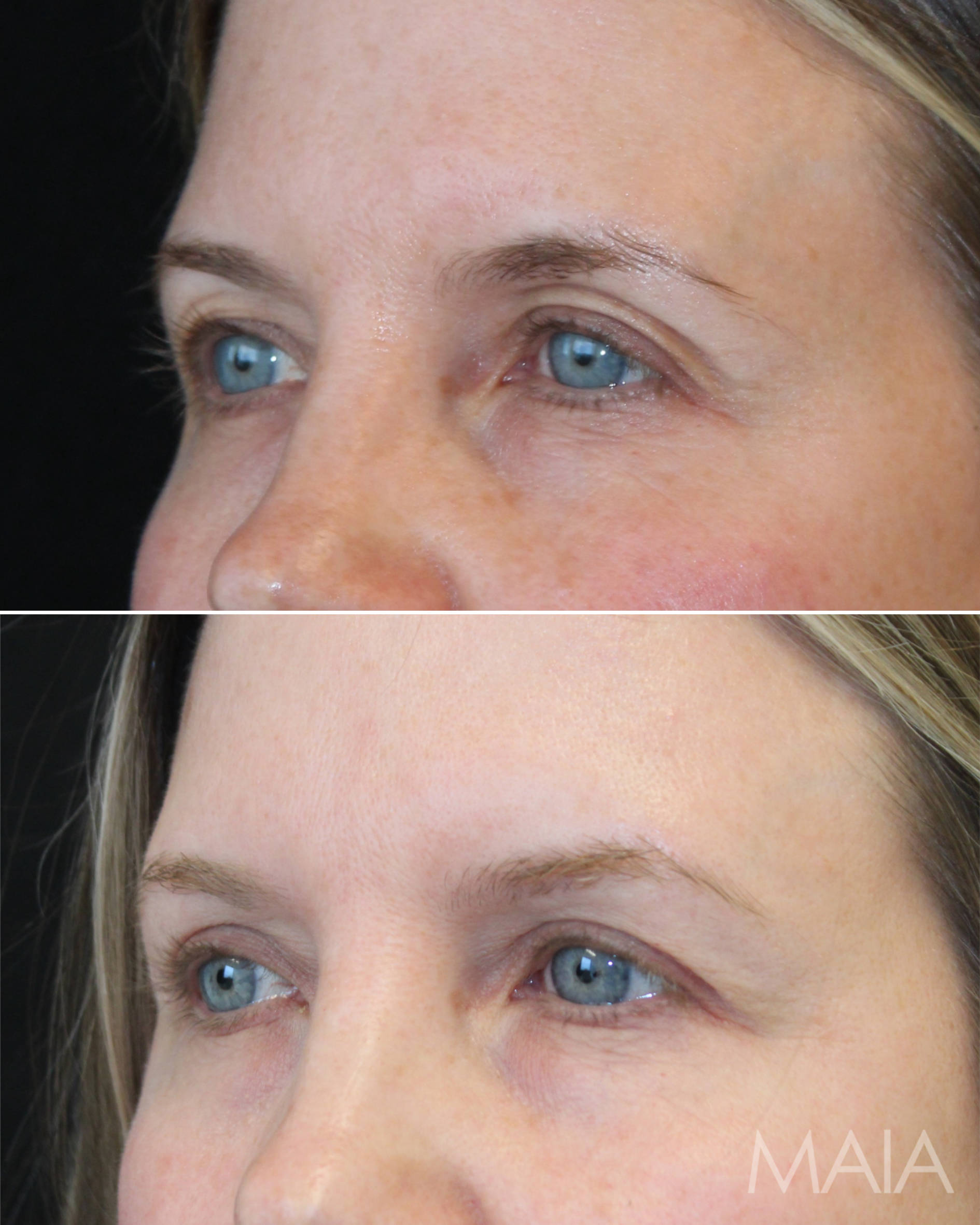 48 year-old before and 6 months after upper eyelid lift with Dr. Maia in Tysons Corner, VA