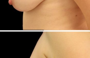 44 year old 2.5 months after breast lift (Not pictured: Tummy Tuck + 360 Lipo)