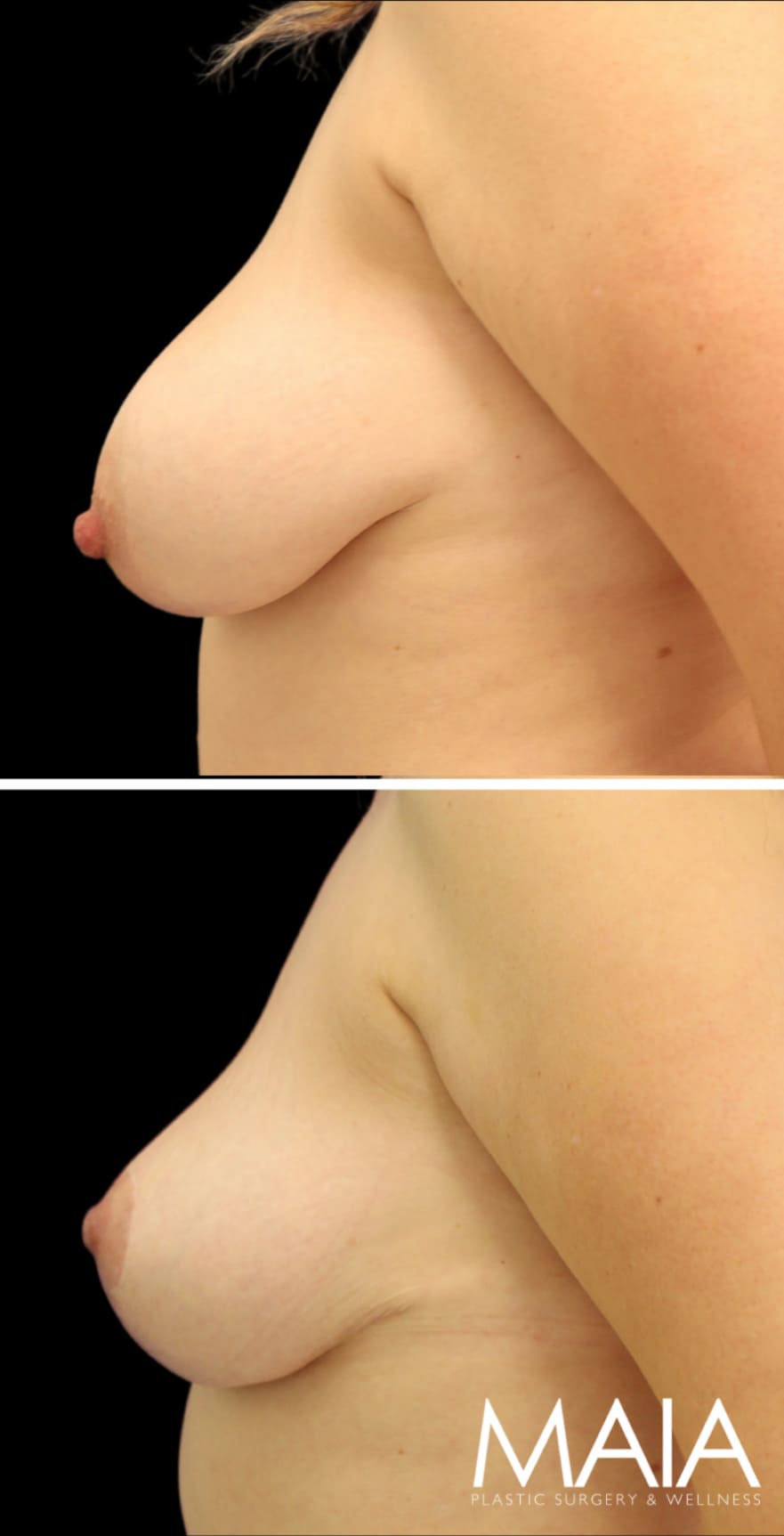 44 year old 2.5 months after breast lift (Not pictured: Tummy Tuck + 360 Lipo)
