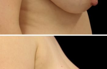 44 year old 2.5 months after breast lift (Not pictured: Tummy Tuck + 360 Lipo)