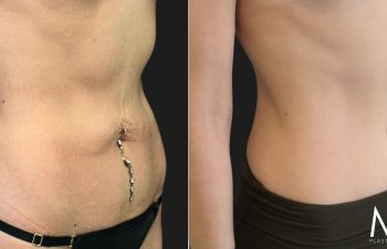 34 year-old before and 8 months after tummy tuck with Dr. Maia in Tysons Corner, Virginia.