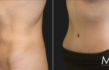 34 year-old before and 8 months after tummy tuck with Dr. Maia in Tysons Corner, Virginia.