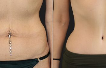 34 year-old before and 8 months after tummy tuck with Dr. Maia in Tysons Corner, Virginia.