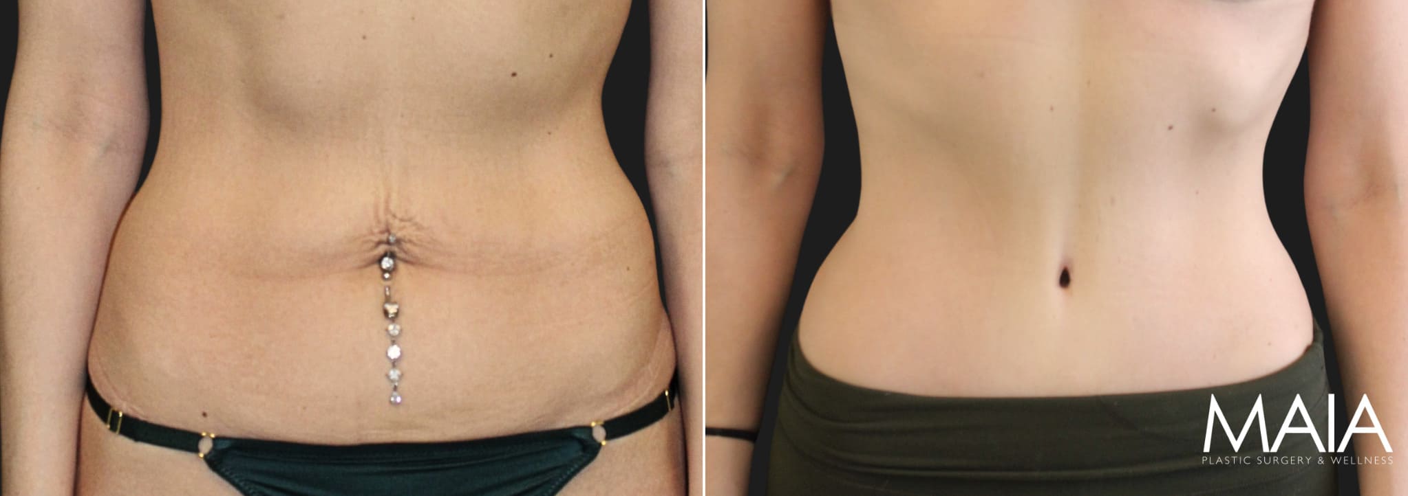 34 year-old before and 8 months after tummy tuck with Dr. Maia in Tysons Corner, Virginia.