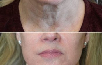 64 year-old before and 9 months after comprehensive facial rejuvenation including deep plane facelift, neck lift, mini temple lift, upper blepharoplasty, nanofat and fat grafting