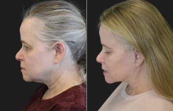 64 year-old before and 9 months after comprehensive facial rejuvenation including deep plane facelift, neck lift, mini temple lift, upper blepharoplasty, nanofat and fat grafting