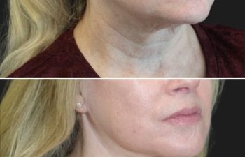 64 year-old before and 9 months after comprehensive facial rejuvenation including deep plane facelift, neck lift, mini temple lift, upper blepharoplasty, nanofat and fat grafting