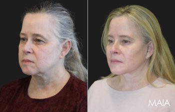 64 year-old before and 9 months after comprehensive facial rejuvenation including deep plane facelift, neck lift, mini temple lift, upper blepharoplasty, nanofat and fat grafting