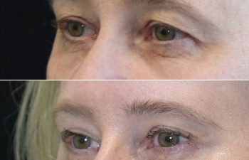 64 year-old before and 9 months after comprehensive facial rejuvenation including deep plane facelift, neck lift, mini temple lift, upper blepharoplasty, nanofat and fat grafting