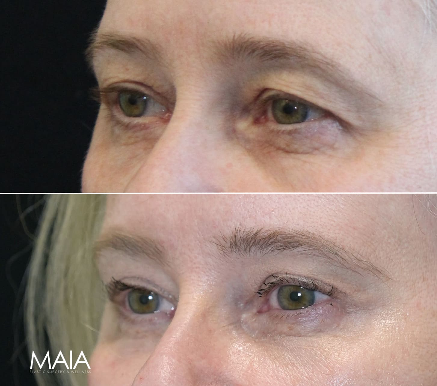 64 year-old before and 9 months after comprehensive facial rejuvenation including deep plane facelift, neck lift, mini temple lift, upper blepharoplasty, nanofat and fat grafting