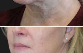 64 year-old before and 9 months after comprehensive facial rejuvenation including deep plane facelift, neck lift, mini temple lift, upper blepharoplasty, nanofat and fat grafting
