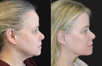 64 year-old before and 9 months after comprehensive facial rejuvenation including deep plane facelift, neck lift, mini temple lift, upper blepharoplasty, nanofat and fat grafting
