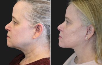64 year-old before and 9 months after comprehensive facial rejuvenation including deep plane facelift, neck lift, mini temple lift, upper blepharoplasty, nanofat and fat grafting