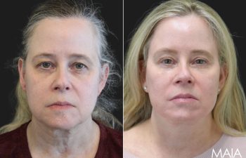 64 year-old before and 9 months after comprehensive facial rejuvenation including deep plane facelift, neck lift, mini temple lift, upper blepharoplasty, nanofat and fat grafting