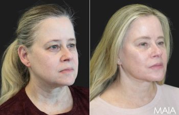 64 year-old before and 9 months after comprehensive facial rejuvenation including deep plane facelift, neck lift, mini temple lift, upper blepharoplasty, nanofat and fat grafting