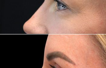 Side-by-side close-up images show a woman's face in profile before (top) and after (bottom) a cosmetic procedure, highlighting changes around the eye and brow area.