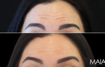 45 year-old before and 2 weeks after botox