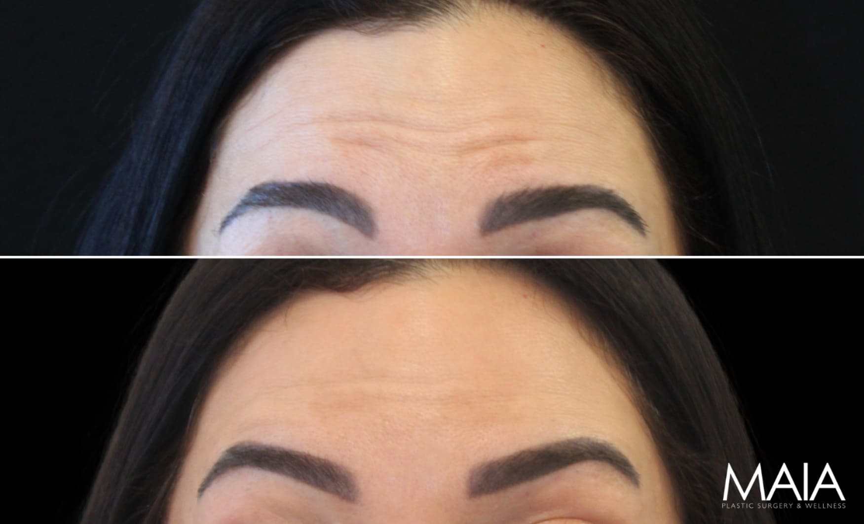 45 year-old before and 2 weeks after botox