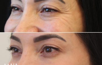 45 year-old before and 2 weeks after botox