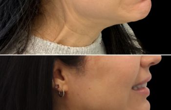 45 year-old before and 2 weeks after botox