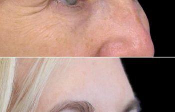57 year-old before and 3 months after upper eyelid lift (upper blepharoplasty), lower eyelid surgery (lower blepharoplasty), brow lift, fat grafting to the face, and a TCA peel