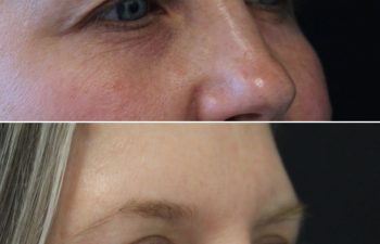 48 year-old before and 6 months after upper eyelid lift with Dr. Maia in Tysons Corner, VA