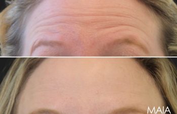 46 year-old patient before and 3 weeks and 4 days after Botox