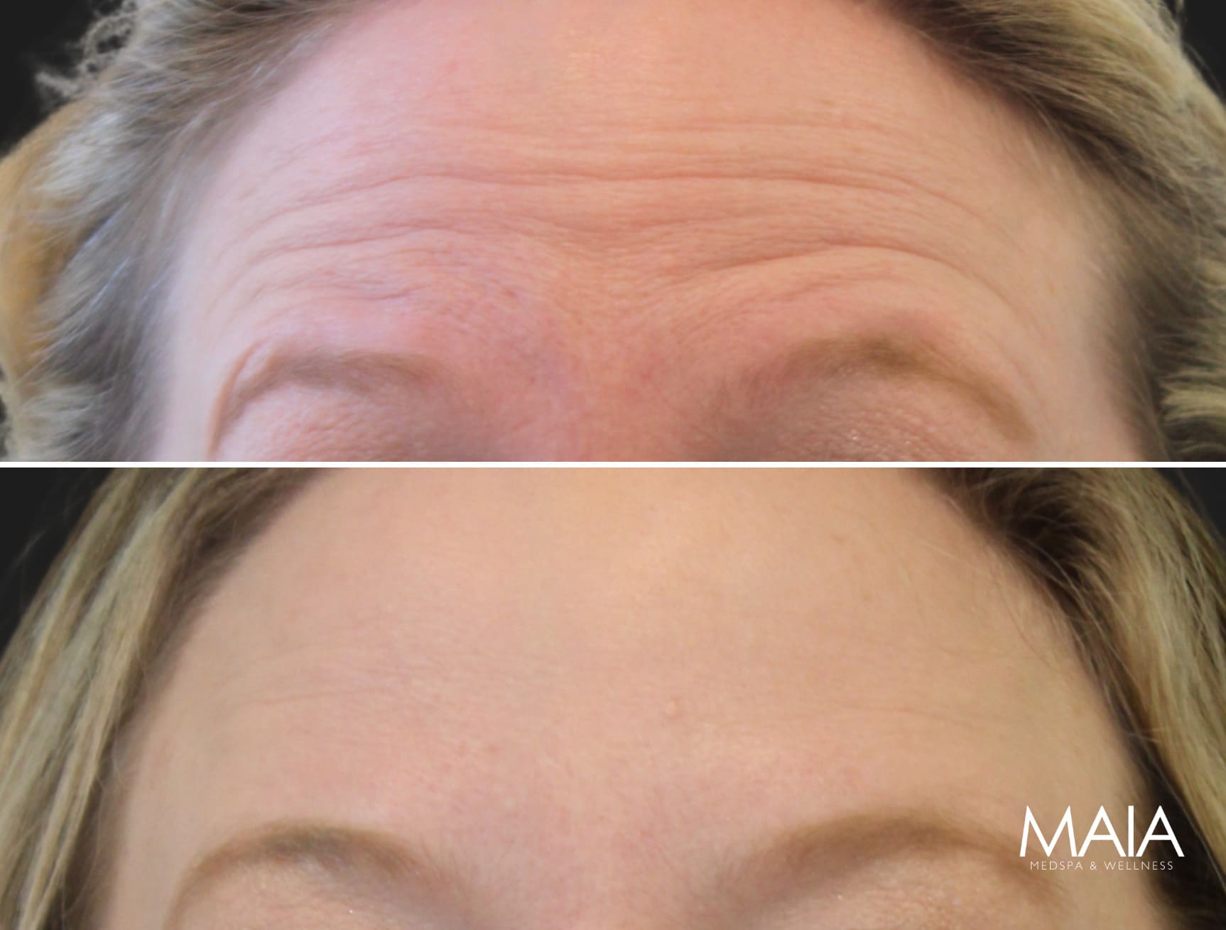 46 year-old patient before and 3 weeks and 4 days after Botox