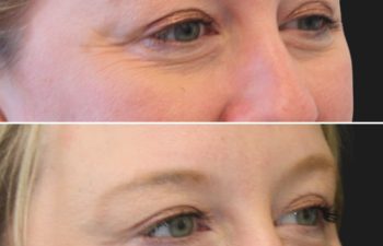 46 year-old patient before and 3 weeks and 4 days after Botox
