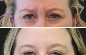 46 year-old patient before and 3 weeks and 4 days after Botox