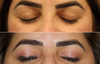 39 year old before and 2.5 months after upper blepharoplasty