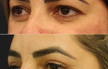 39 year old before and 2.5 months after upper blepharoplasty