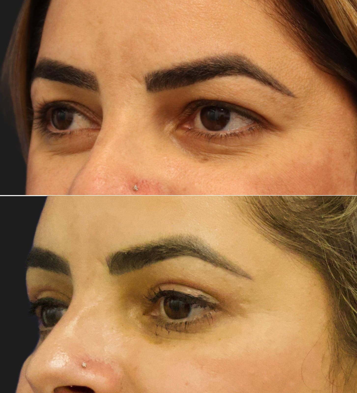 39 year old before and 2.5 months after upper blepharoplasty