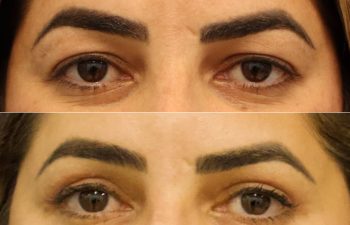 39 year old before and 2.5 months after upper blepharoplasty