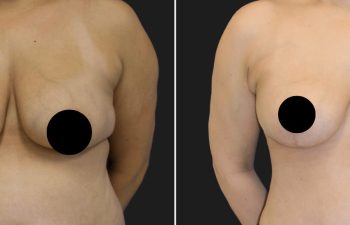 patient before and after procedure