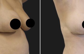 patient before and after procedure