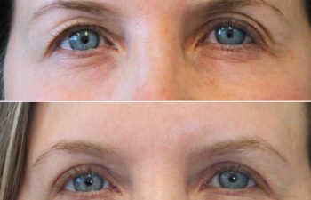 48 year-old before and 6 months after upper eyelid lift with Dr. Maia in Tysons Corner, VA