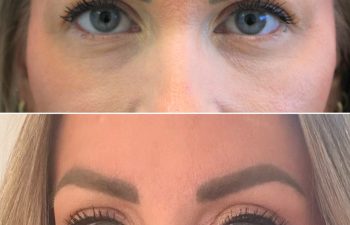 46 year-old with makeup before and 2 months after eyelid lift