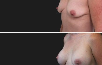 35 year-old before and 7 months after breast augmentation | Implant Size: 375cc high profile