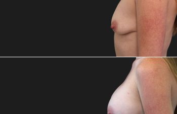 35 year-old before and 7 months after breast augmentation | Implant Size: 375cc high profile