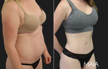 35 year-old before and 7 months after breast augmentation | Implant Size: 375cc high profile