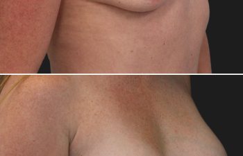 35 year-old before and 7 months after breast augmentation | Implant Size: 375cc high profile