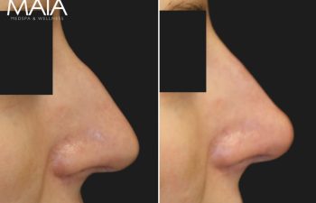 40 year-old before and immediately after liquid rhinoplasty