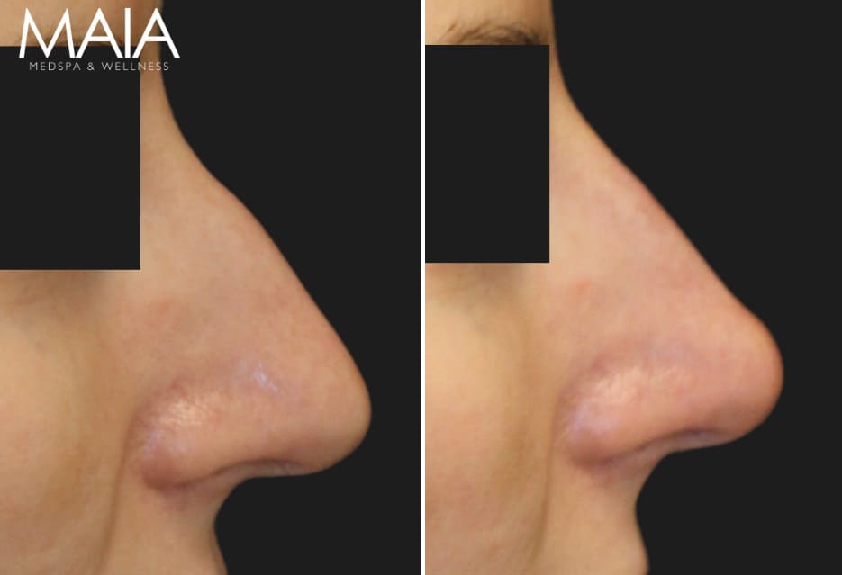 40 year-old before and immediately after liquid rhinoplasty
