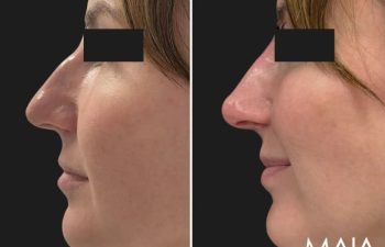 40 year-old before and immediately after liquid rhinoplasty