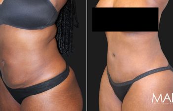 36 year-old before and 3 months post-op extended tummy tuck and liposuction of the flanks and abdomen